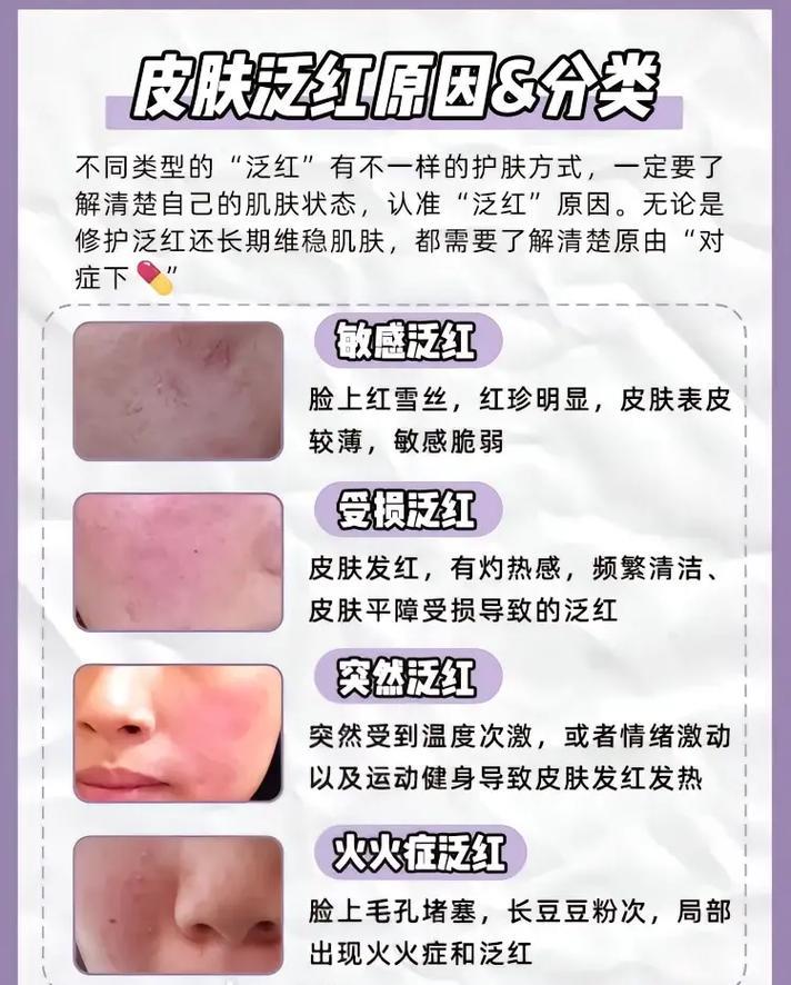 皮肤泛红怎么快速消退？