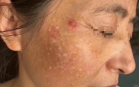 祛斑反黑可以退吗？